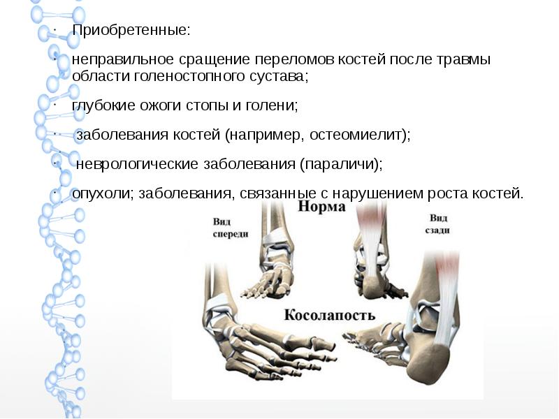 Скачать презентацию дисплазия тазобедренного сустава