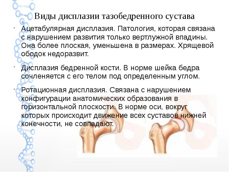 Скачать презентацию дисплазия тазобедренного сустава