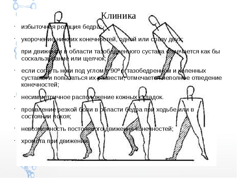 Скачать презентацию дисплазия тазобедренного сустава