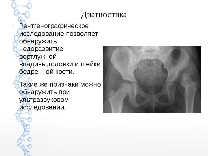 Скачать презентацию дисплазия тазобедренного сустава