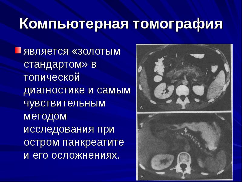 Презентация по хирургии острый панкреатит