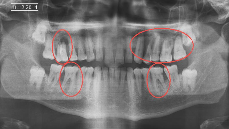 Рентгенологическая картина пародонтоз