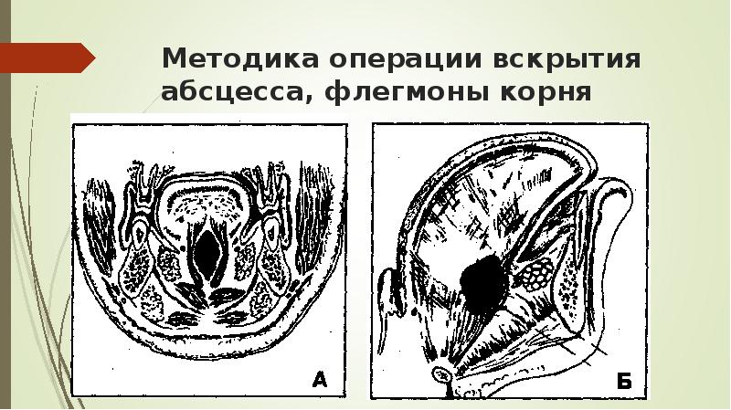 Флегмона корня языка фото