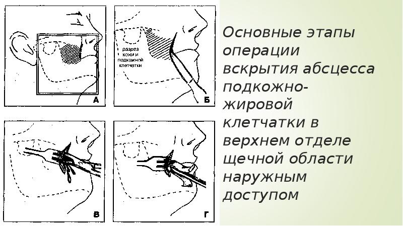 Абсцесс языка фото