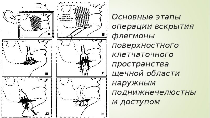 Чем отличается флегмона от абсцесса