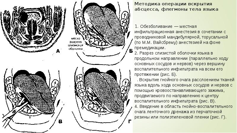 Флегмона корня языка фото