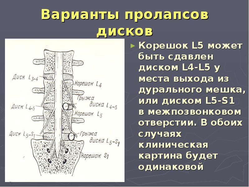 Дуральный мешок позвоночника. Дуральный мешок позвоночника анатомия. Дуральное пространство позвоночника это. Дуральный мешочек. Корешок l5.