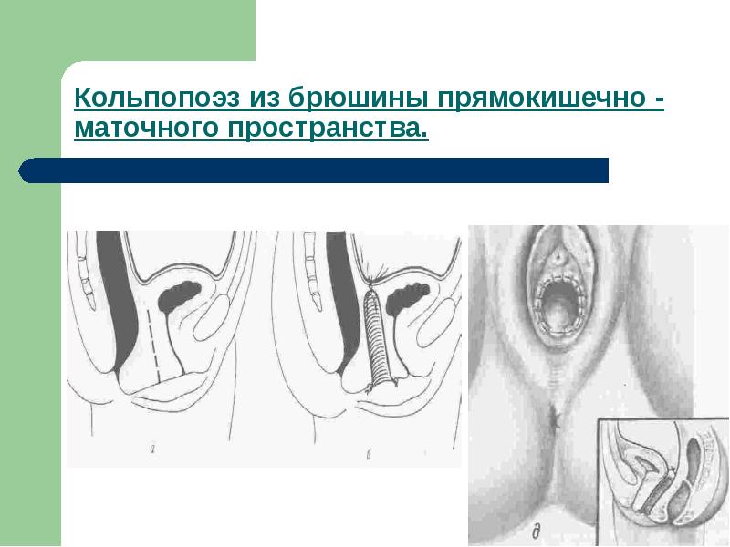 Аномалии развития женских половых органов