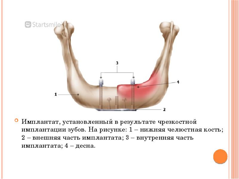 Имплантат, установленный в результате чрезкостной имплантации зубов. На рисунке: 1 – Имплантат, установленный в результате чрезкостной имплантации зубов. На рисунке: 1 –