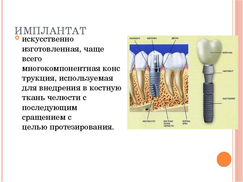 Имплантат
искусственно изготовленная, чаще всего многокомпонентная конструкция, используемая для внедрения в костную ткань челюсти с Имплантат
искусственно изготовленная, чаще всего многокомпонентная конструкция, используемая для внедрения в костную ткань челюсти с