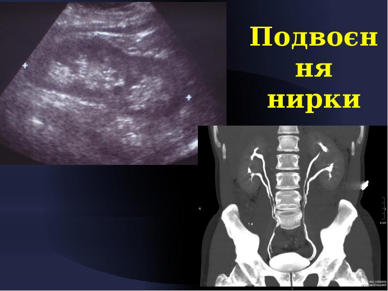 Удвоение почки. Удвоение почки на УЗИ. Удвоенная почка на УЗИ. Неполное удвоение почки на УЗИ. УЗИ почек удвоение ЧЛС.