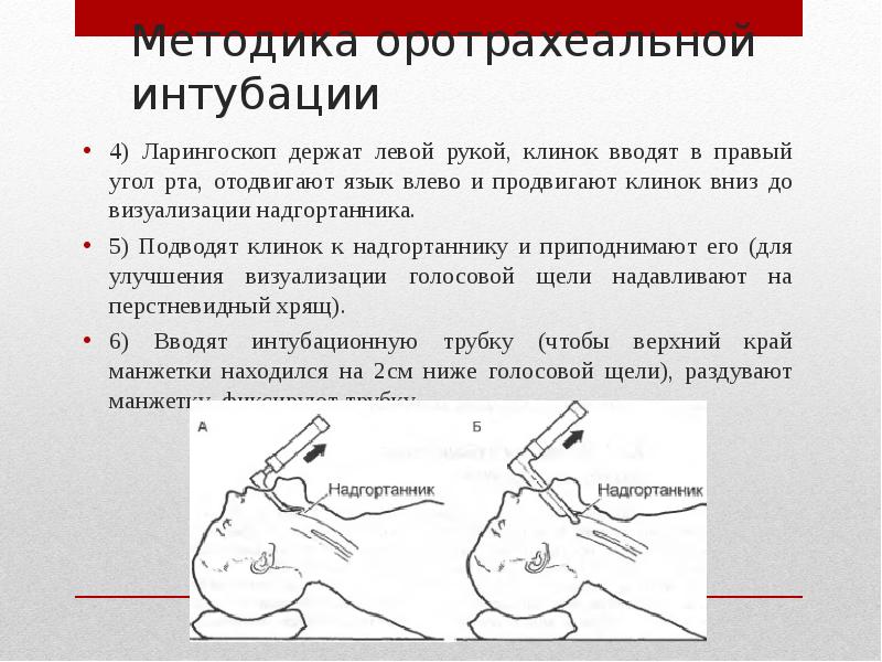 Интубация трахеи. Клинок для интубации трахеи. Интубация трахеи оротрахеальная. Методика оротрахеальной интубации. Интубация трахеи методика.