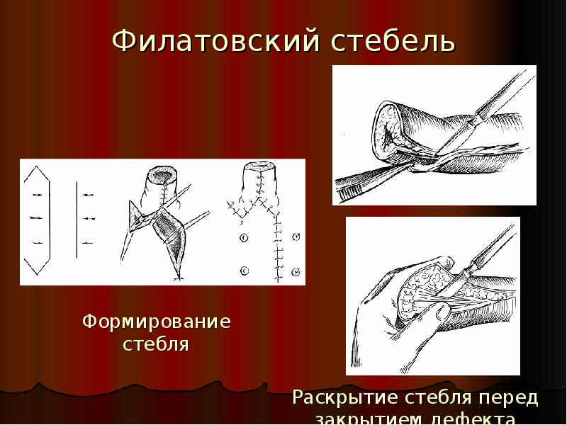 Схема кожной пластики филатовским стеблем