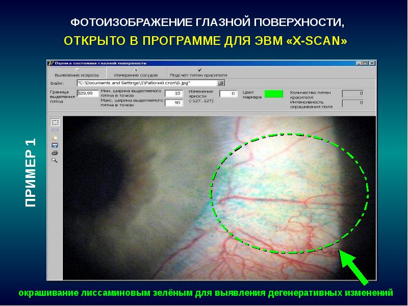 Диагностика изменений. Что такое окрашивание глазной поверхности. Заболевания глазной поверхности. Окрашивание роговицы лиссаминовым зеленым.