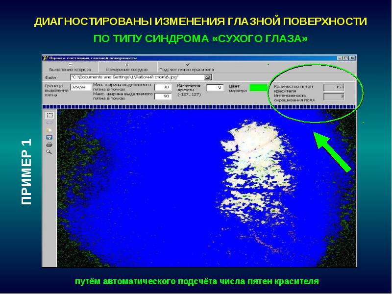 Диагностика изменений. Диагностические изменения. Тест с окрашиванием глазной поверхности. М-НДР вид поверхности.