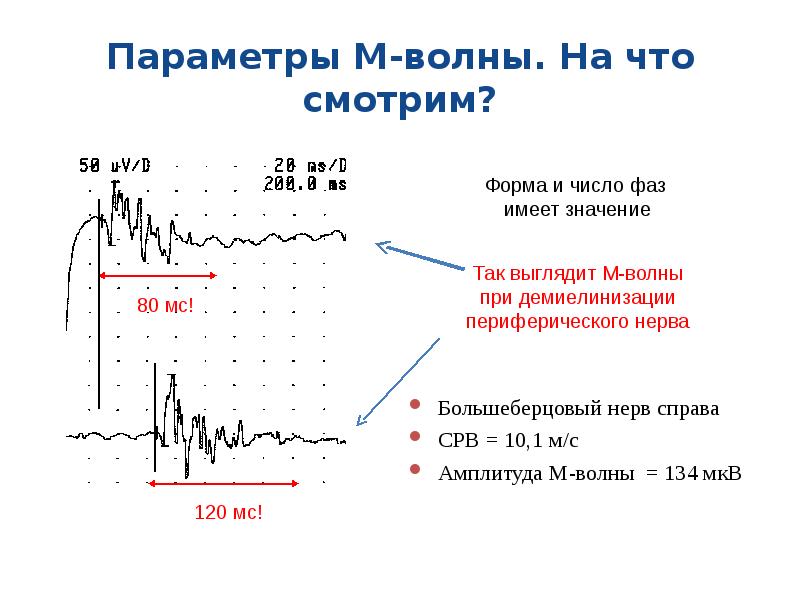 Т м ответ. ЭМГ показатели в норме. ЭНМГ интерпретация результатов. Электронейромиография интерпретация результатов.