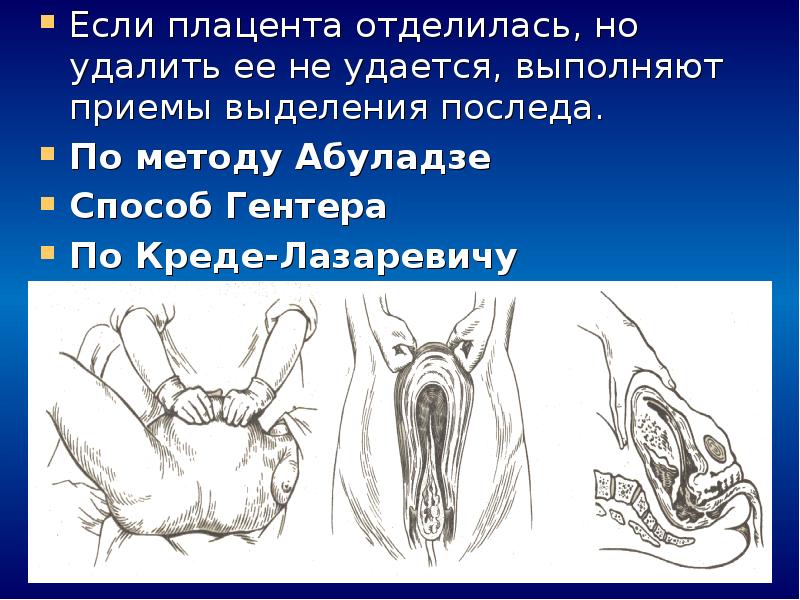 Признаки отделения плаценты. Отделение последа по методу Абуладзе. Способы выделения последа (Абуладзе, Креде-Лазаревича, Гентера). Способ Абуладзе отделения последа. Способы выделения последа (Абуладзе, Креде-Лазаревича).