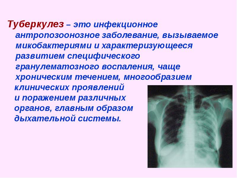 Появление туберкулеза. Туберкулез поражение легких. Туберкулез заболевание кратко.