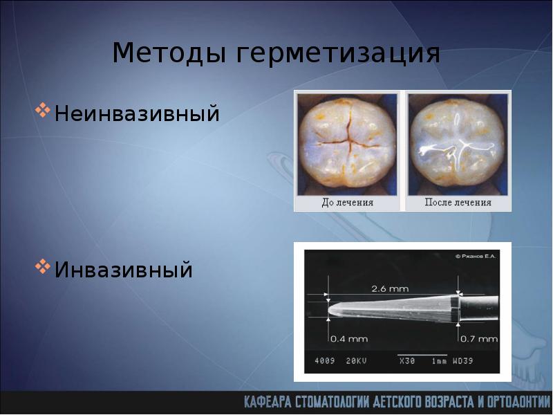 Герметизация фиссур презентация