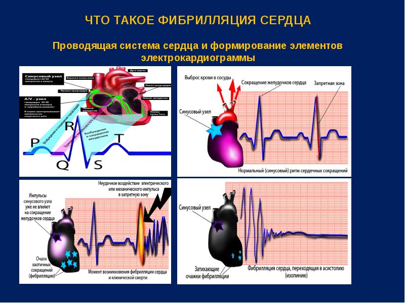 Фибрилляция сердца. Фибрилляция сосудов сердца. Проводящая система сердца ЭКГ. Что вызывает фибрилляцию сердца?.