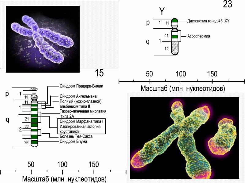 Хромосомы мальчика. Синдром Прадера Вилли хромосома. Синдром Прадера -Вилли делеция 15 хромосомы. Синдром Ангельмана кариотип. Синдром Энгельмана кариотип.
