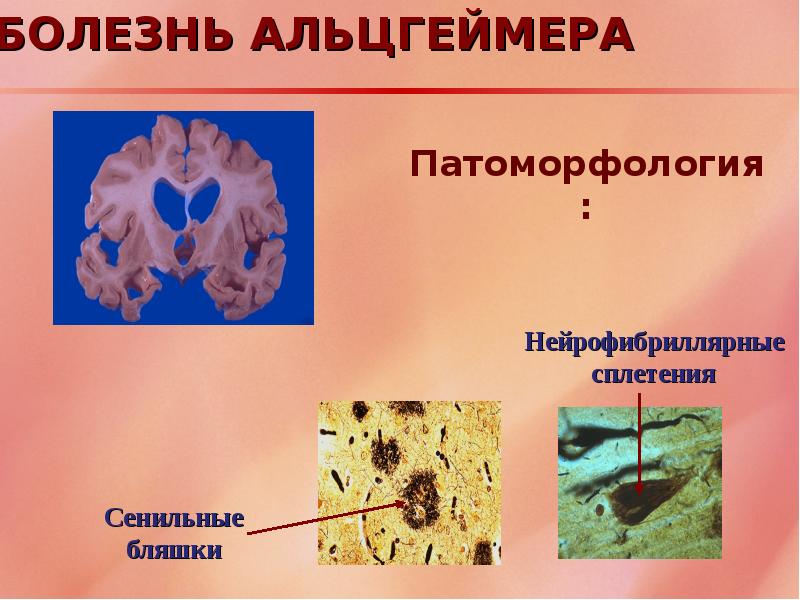 Болезнь альцгеймера презентация