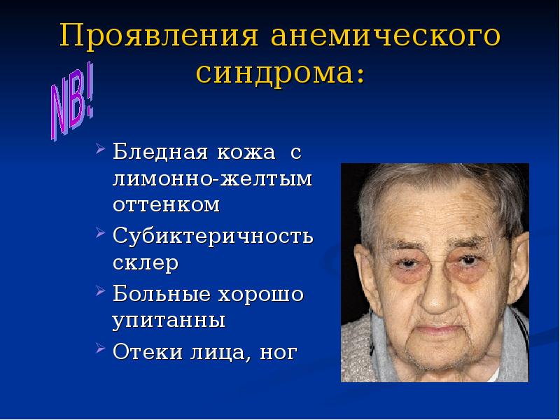 Проявления анемического синдрома: Бледная кожа с лимонно-желтым оттенком Субиктеричность склер Больные