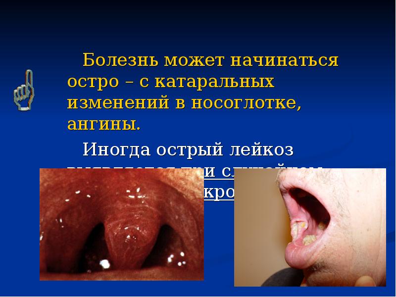 Болезнь может начинаться остро – с катаральных изменений в носоглотке, ангины.