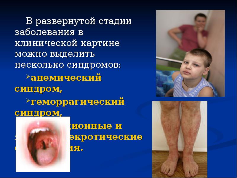 В развернутой стадии заболевания в клинической картине можно выделить несколько синдромов: