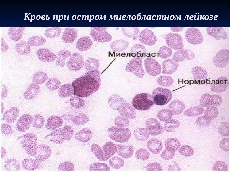 Кровь при остром миелобластном лейкозе