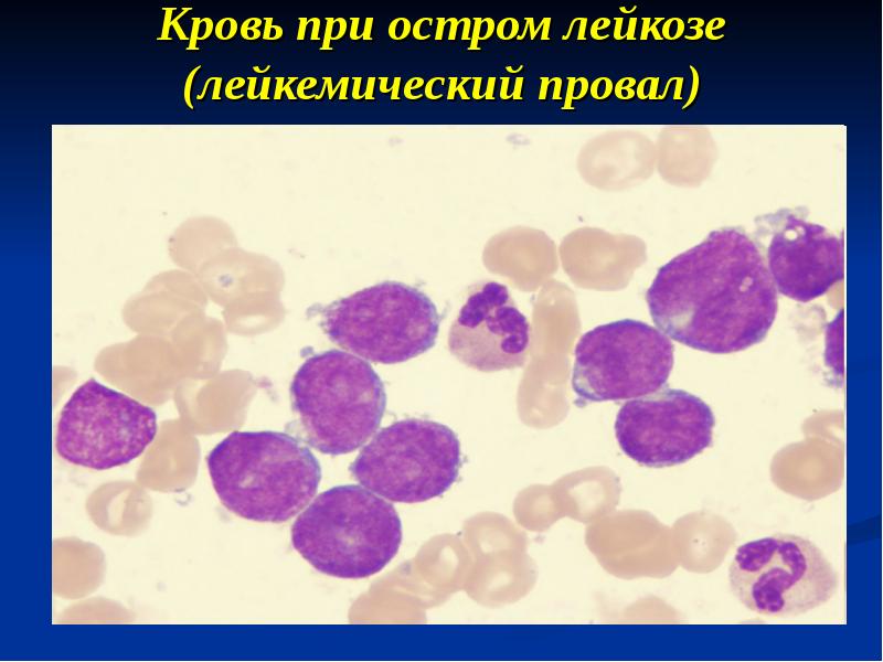 Кровь при остром лейкозе (лейкемический провал)