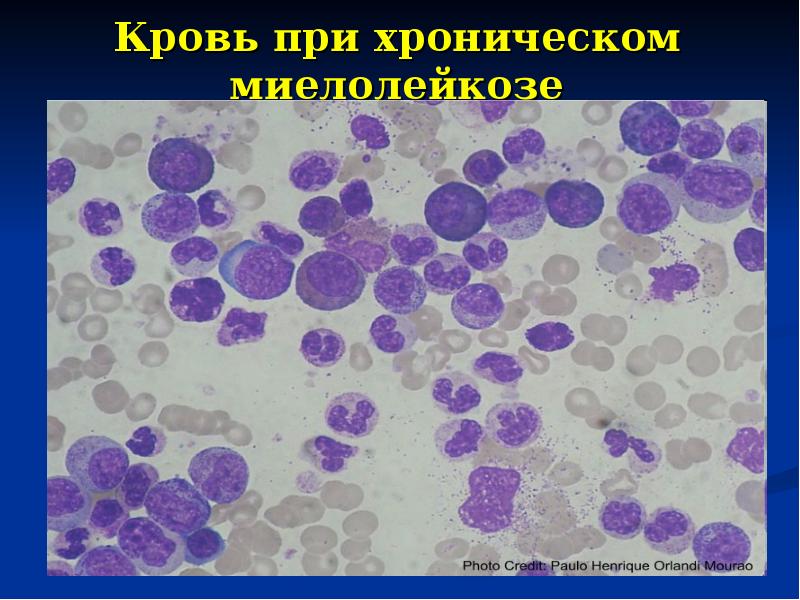 Хронический миелолейкоз презентация