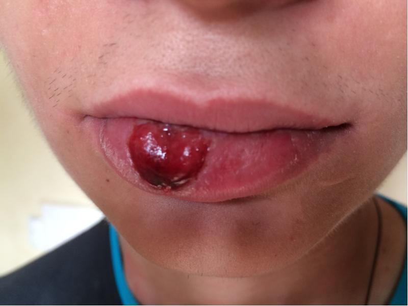  симптом сифилиса на губе 