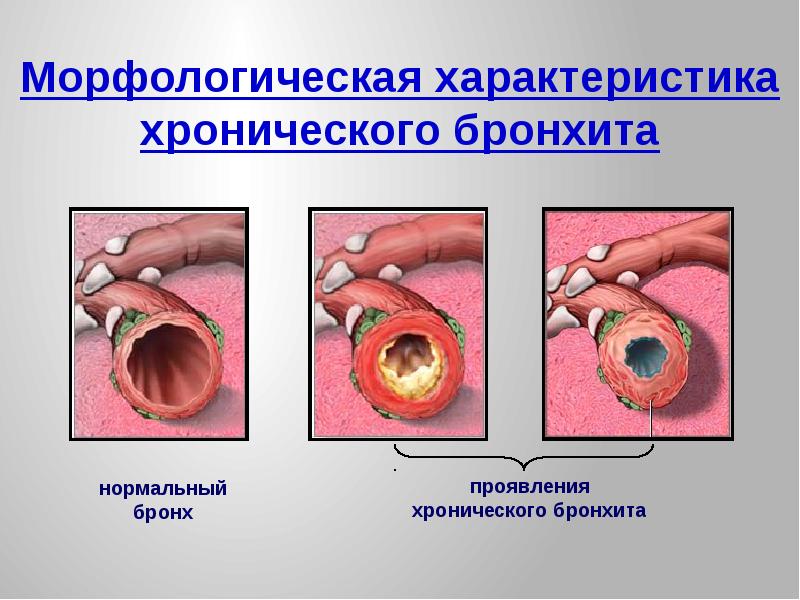 Хронический бронхит картинки для презентации