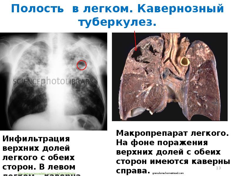 Синдром полости в легком презентация