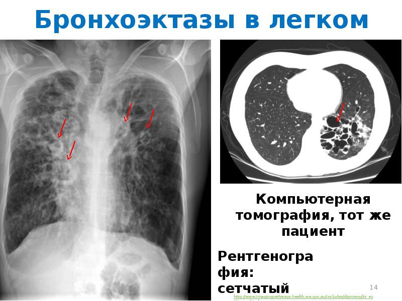 Синдром полости в легком презентация