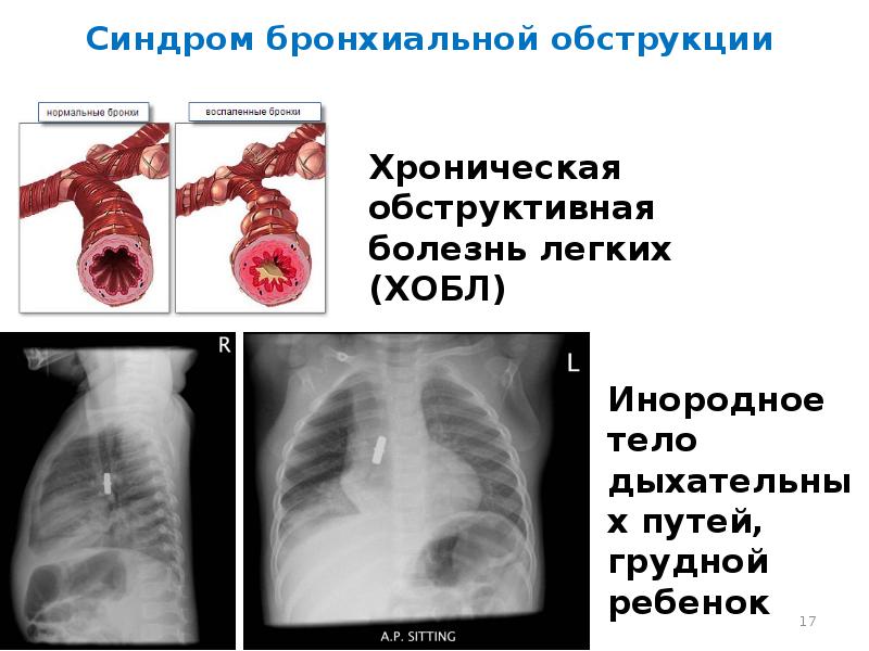 Синдром полости в легком презентация