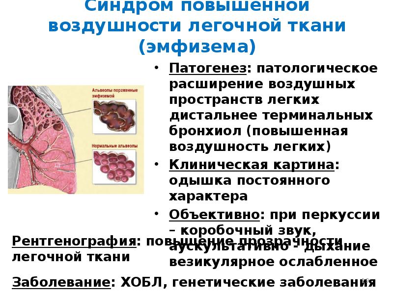 Синдром полости в легком презентация