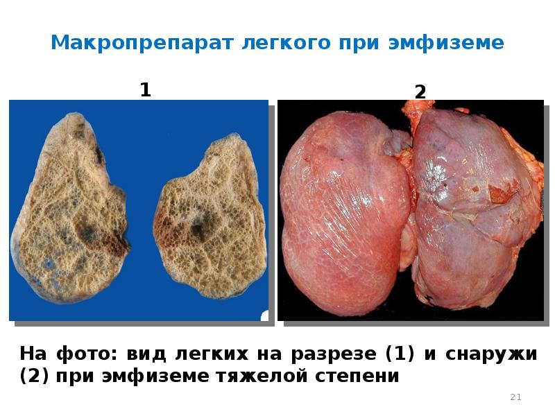 Синдром полости в легком презентация