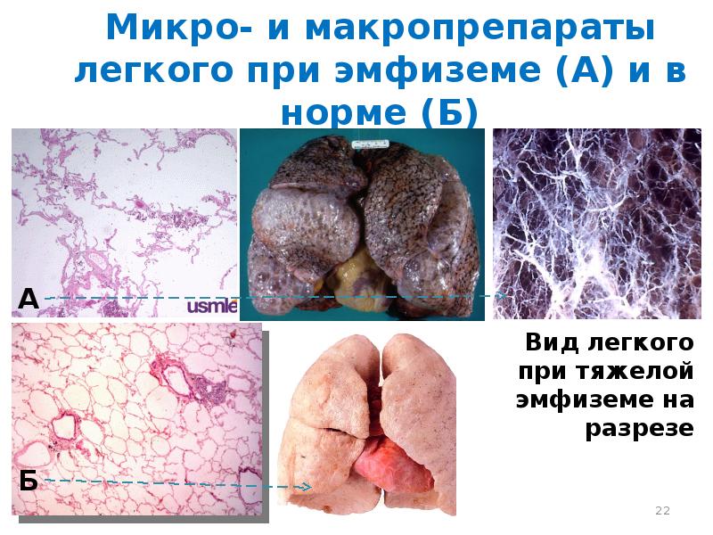 Синдром полости в легком презентация