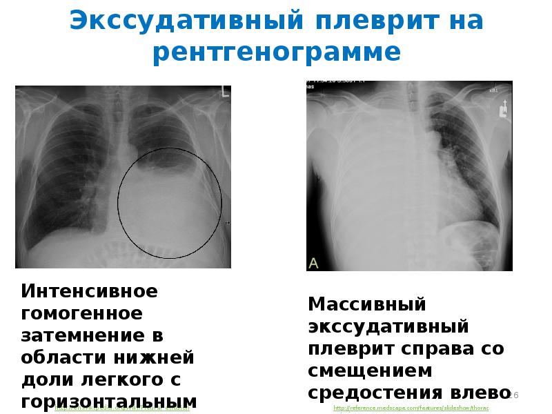 Синдром полости в легком презентация