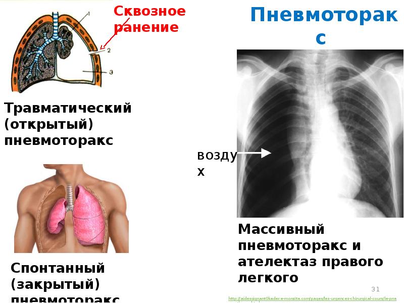 Синдром полости в легком презентация