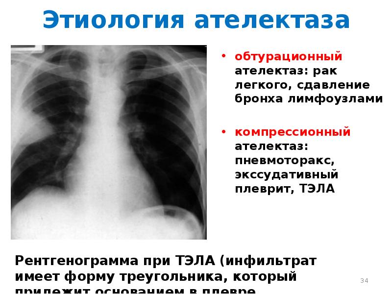 Ателектаз легкого