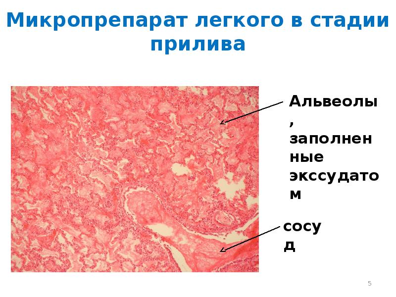 Синдром полости в легком презентация