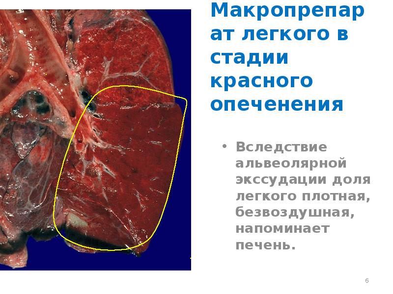 Синдром полости в легком презентация