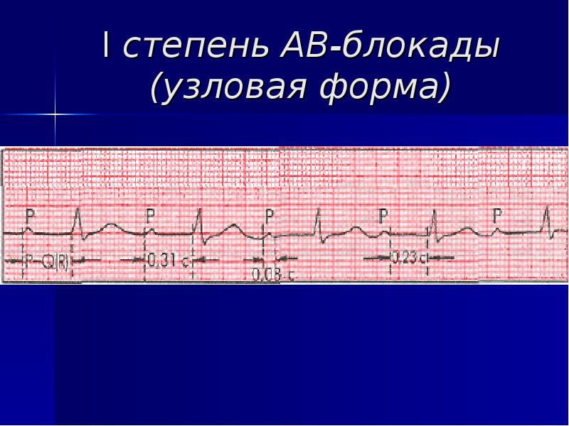 Блокада первой степени. АВ блокада 1 степени Узловая форма на ЭКГ. АВ Узловая блокада на ЭКГ. Узловая форма av блокады 1 степени. Проксимальная форма АВ блокады 3.