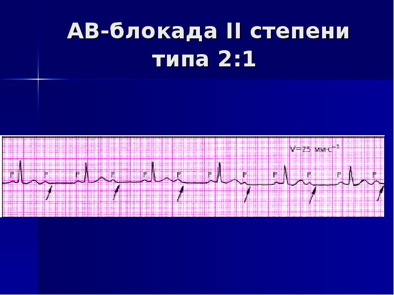 Блокада на первом. АВ блокада 2 степени 2 1 на ЭКГ. АВ блокада 2 степени 2 типа 2:1. АВ блокада 2 степени 1 типа Мобиц. Атриовентрикулярная блокада 1 степени 2 типа ЭКГ.