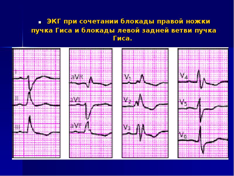 Блокады на экг. ЭКГ при блокаде левой задней ветви пучка Гиса. Двухпучковая блокада ножек пучка Гиса на ЭКГ. Угол Альфа при блокаде передней ветви левой ножки. Блокады правой и левой ножек Гиса на ЭКГ.