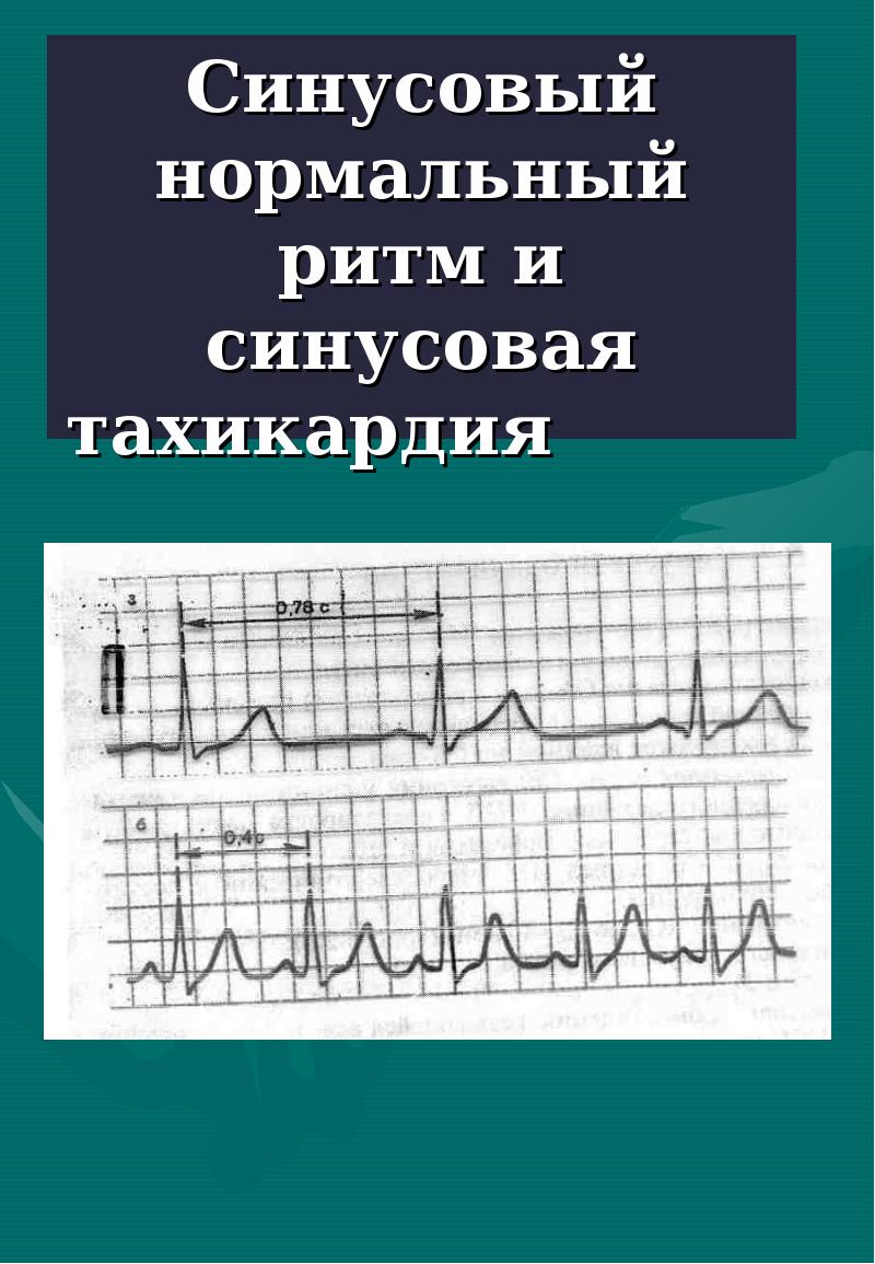 Нормальный ритм. Нормальный синусовый ритм. Синус ритм. Нормальный синусовый ритм сердца. Синусовый ритм тахикардия.