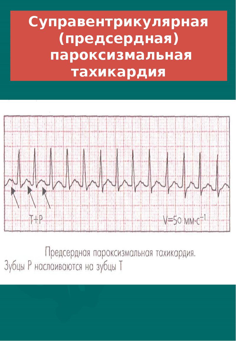 Пароксизмальная тахикардия презентация